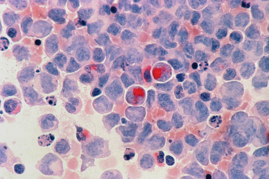 Photo of Acute Myeloid Leukemia